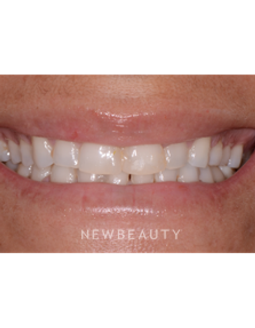 Dr. Irene Grafman - Smile Makeover - Before