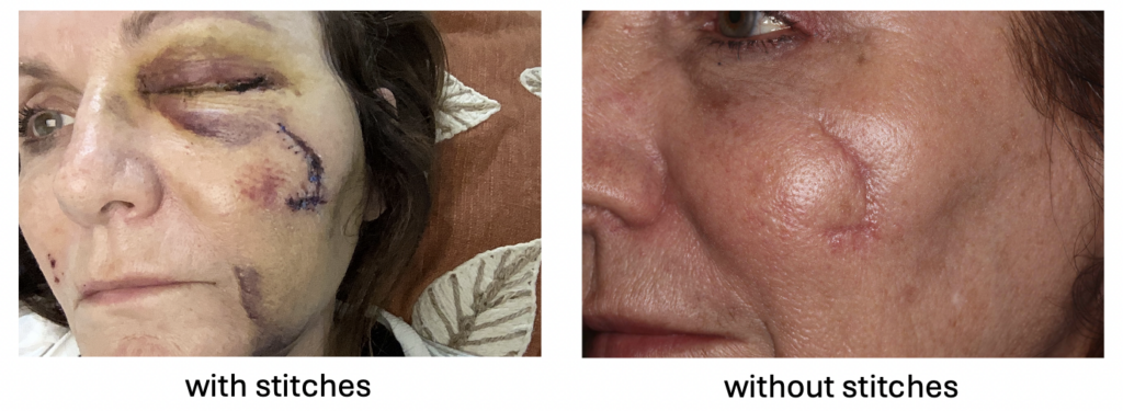 facial scar with and without stitches