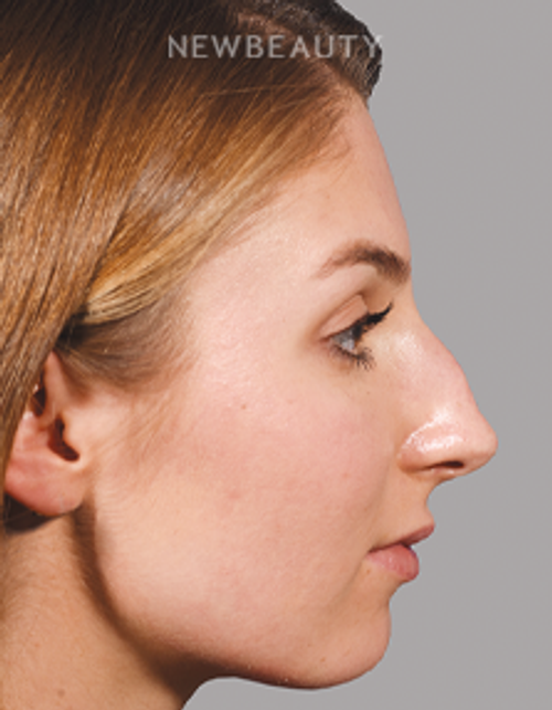Sam P. Most, M.D. - 21009776 - Rhinoplasty - Before