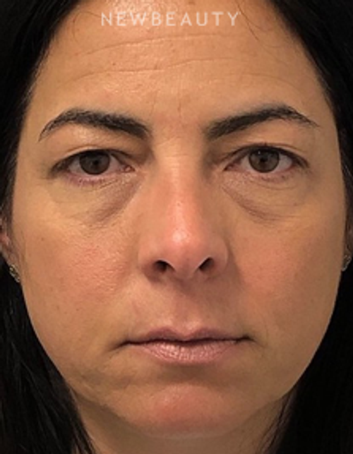 Dr. Dilip Madnani - Upper and Lower Blepharoplasty - 13691651 - Before
