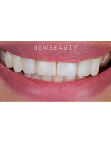 Dr. Husam Almunajed - Smile Makeover Revision - Before