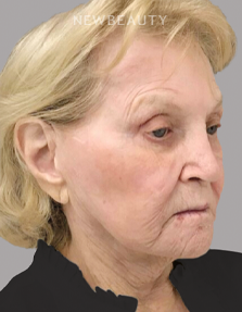 Dr. Janet Allenby - Nonsurgical Skin Tightening - Before