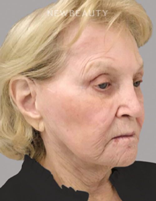 Dr. Janet Allenby - Nonsurgical Skin Tightening - Before