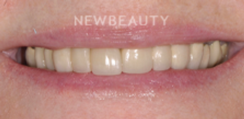 Dr. Salvator La Mastra - Smile Makeover -46107800 - Before
