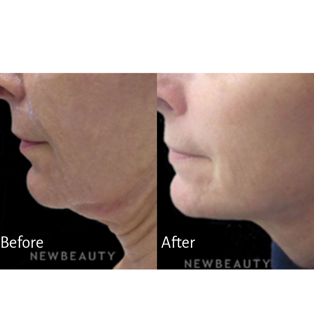 This patient of Dr. Papantoniou received Restylane to address excess skin.