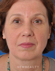Dr. Edward Kwak - Rhinoplasty - After