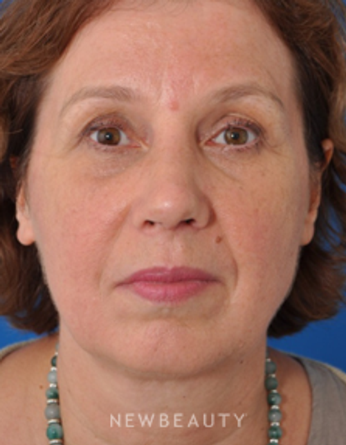 Dr. Edward Kwak - Rhinoplasty - After