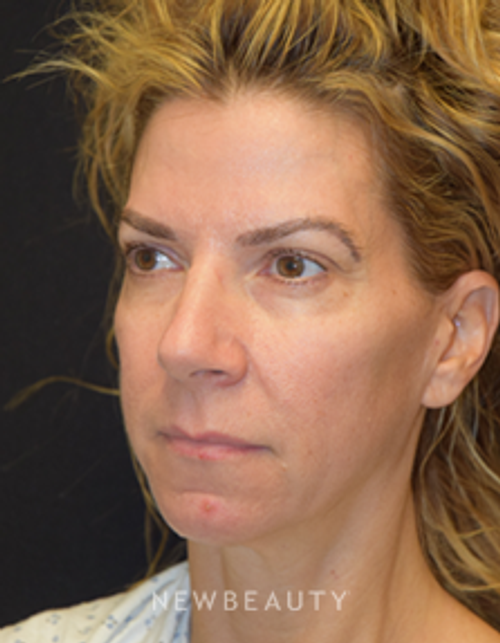 Dr. Jeffrey B. Wise - Chin Implant - Before