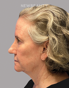 Dr. Paul Afrooz - Beautiful Transformation - 36269784 - Before