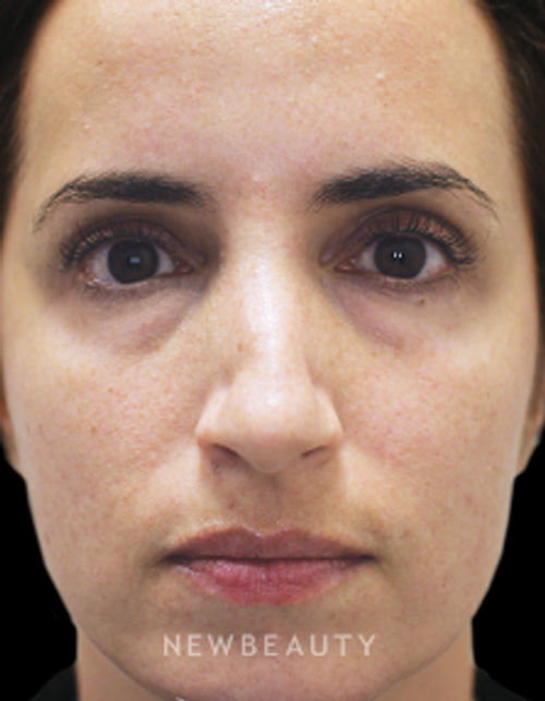 Dr. Gilly Munavalli - Injectables and Fillers - Before