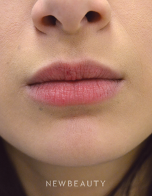 Dr. Julie Russak - Lip Enhancement - Before