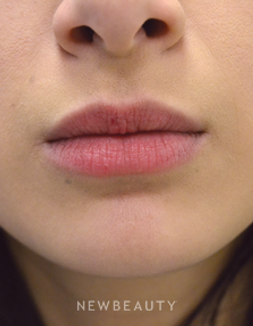 Dr. Julie Russak - Lip Enhancement - Before