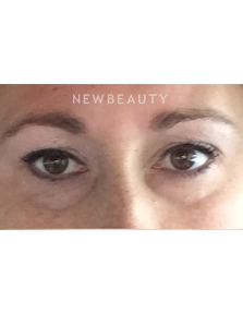 Dr. Janet Allenby - Kybella - Before