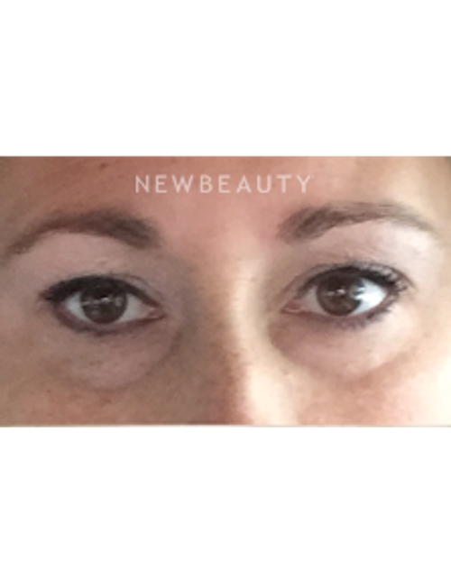 Dr. Janet Allenby - Kybella - Before