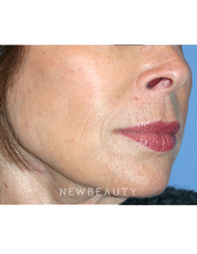 Dr Kelly Bomer Injectable Fillers - After