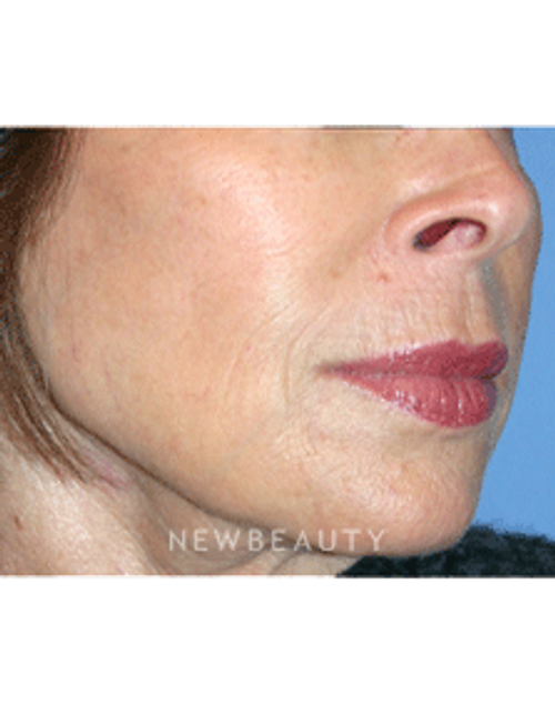 Dr Kelly Bomer Injectable Fillers - After