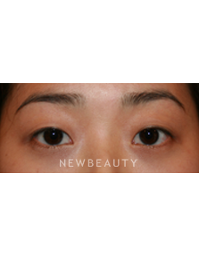 Dr. John Kang - Eyelift - Before