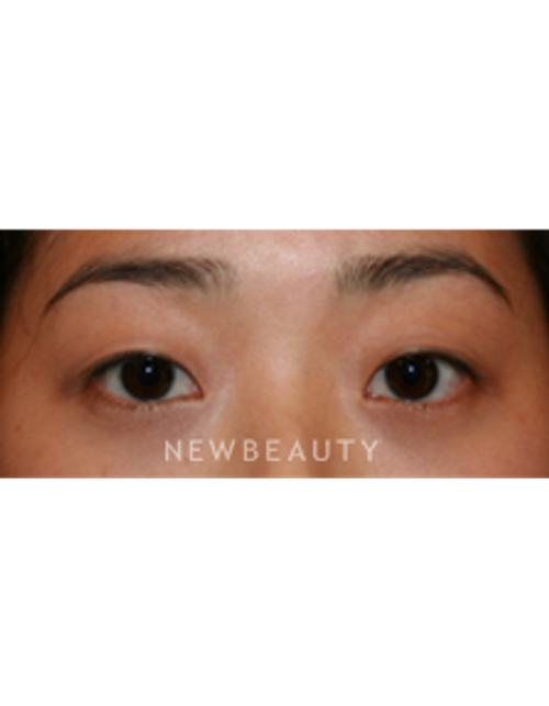 Dr. John Kang - Eyelift - Before