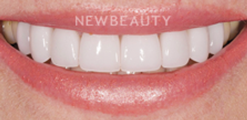Dr. Salvator La Mastra - Veneers - 46106725 - After