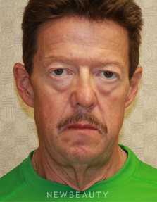 Dr. Dilip D. Madnani - Facelift, Necklift & Eyelift - Before