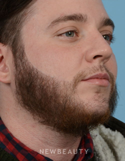 Dr. Jeffrey B. Wise - Hair Transplant - After