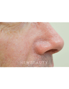 Dr. Julie Russak Facial Laser Treatment - After