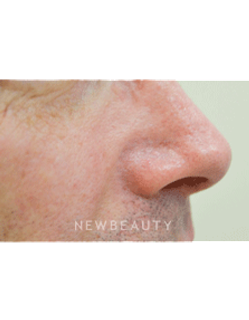 Dr. Julie Russak Facial Laser Treatment - After