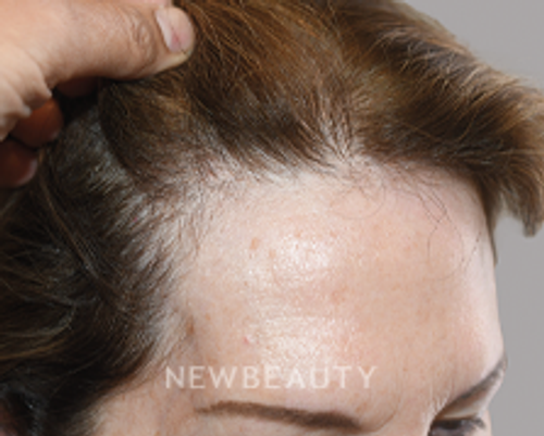 Dr. Jeffrey Epstein - Revived Tresses - 44714605 - After