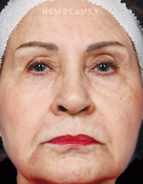 Dr. Kathleen Behr - Injectables - After