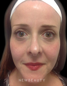 Dr. Julie Russak - Injectables & Fillers - After