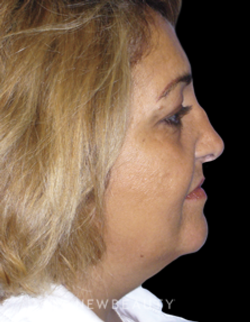 Dr. Elie Levine Facelift, Necklift - Before