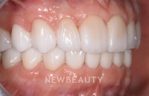 Dr. Sara Cummins - Smile Makeover - 14738055 - After