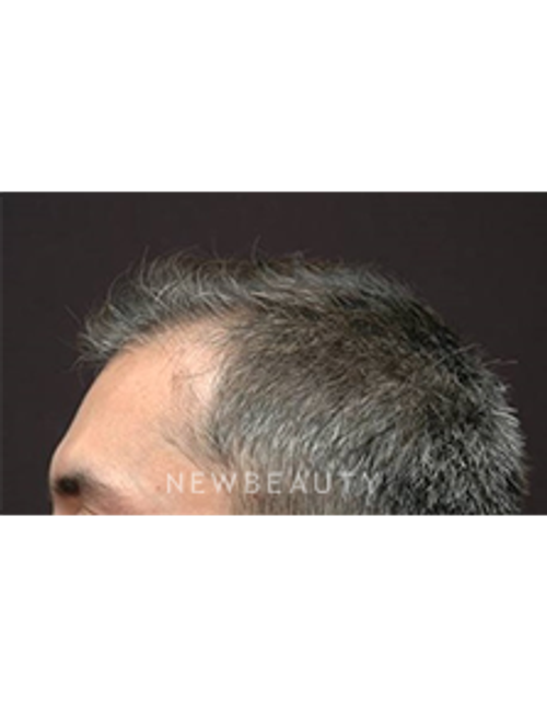 Dr. Jeffrey B. Wise - Hair Loss Treatment - Before