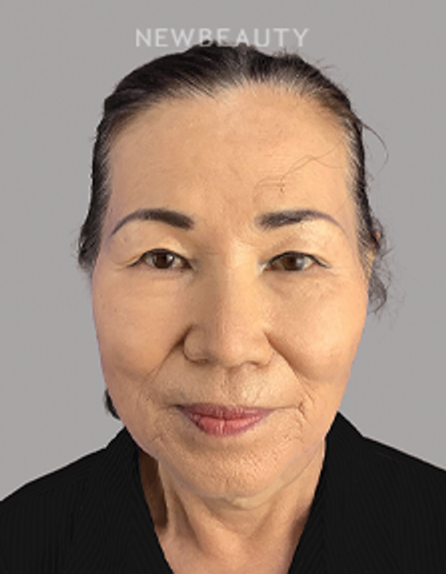 Dr. Sheila Barbarino-Blepharoplasty-547989840 - Before