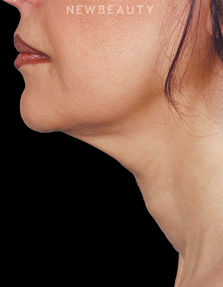 Dr. Ava Shamban - Injectables & Fillers - After