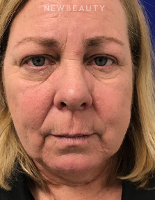 Dr. Dilip Madnani – Liquid Facelift - Before