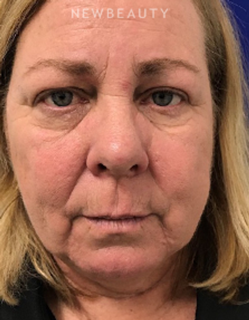 Dr. Dilip Madnani – Liquid Facelift - Before