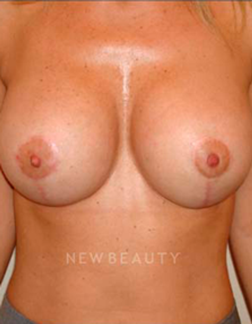 Dr. Michael Horn Breast Lift - After