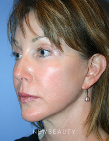 Dr. Kelly Bomer, Facelift, Chin Augmentation - After