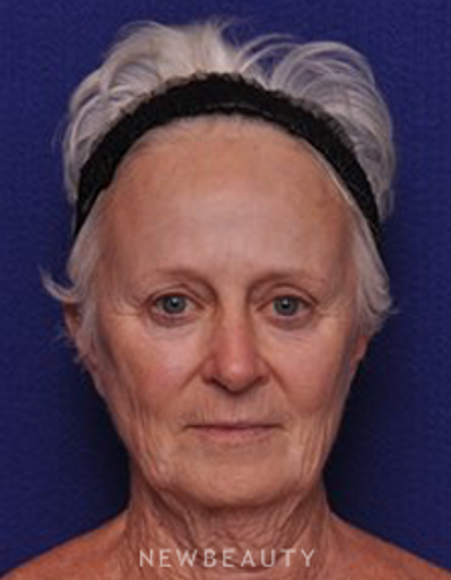 Dr. Alan Durkin - Facelift - Before