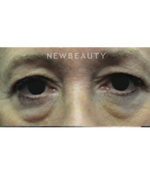 Dr. B. Aviva Preminger - A Fresh Look - Before