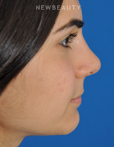 Dr. Edward Kwak - Rhinoplasty - After