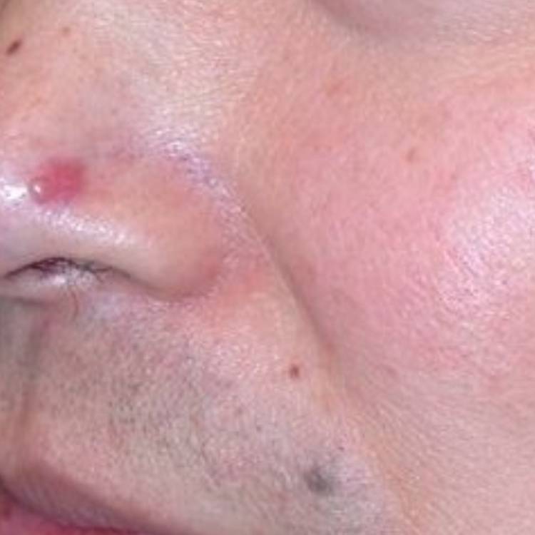 skin cancer on nose