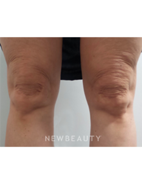 Dr. Marina Peredo - Ulthera - Before