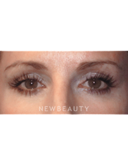 Dr. Christine Hamori Liquid Lift, Belotero, Juvederm - After