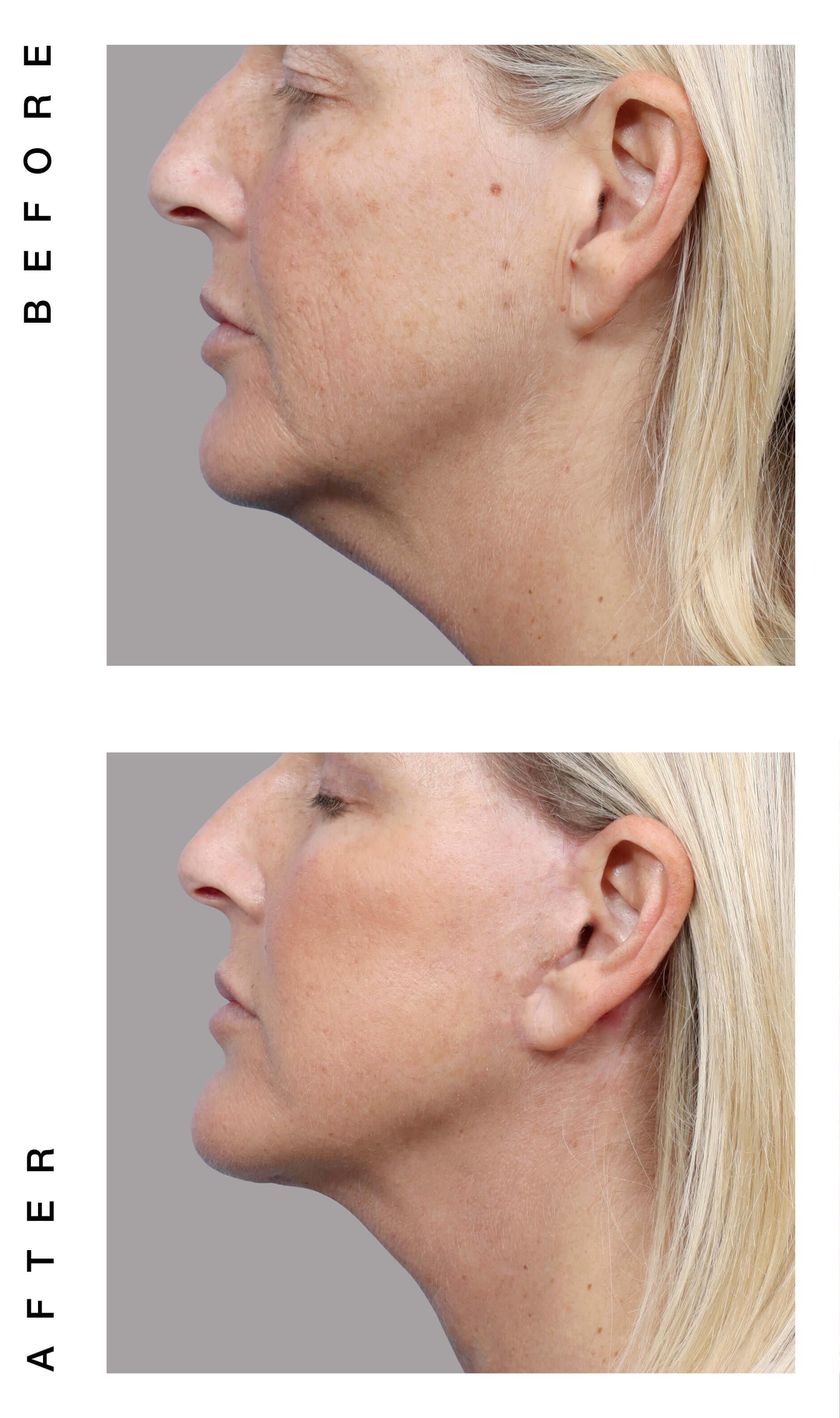 Before and after necklift