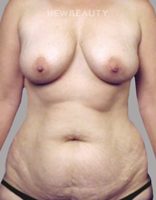 Dr. Miriam Awada - Mommy Makeover - 37027680 - Before
