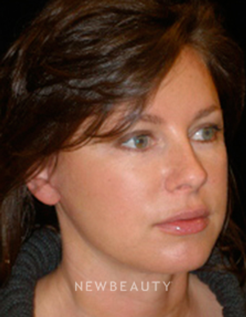 Dr. Phillip Chang Facelift, Eyelift, Lip Augmentation - After