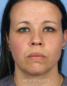 Dr. Kelly Bomer - Injectables & Fillers - Before