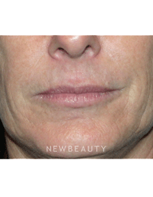 Dr Kelly Bomer Injectable Fillers - Before